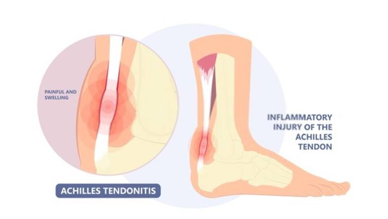 Tendinitis