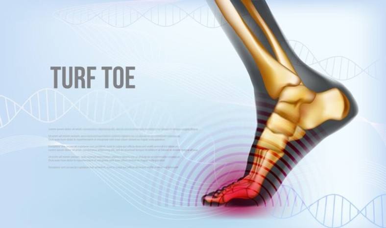 Turf toe