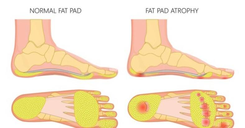 Heel pad atrophy