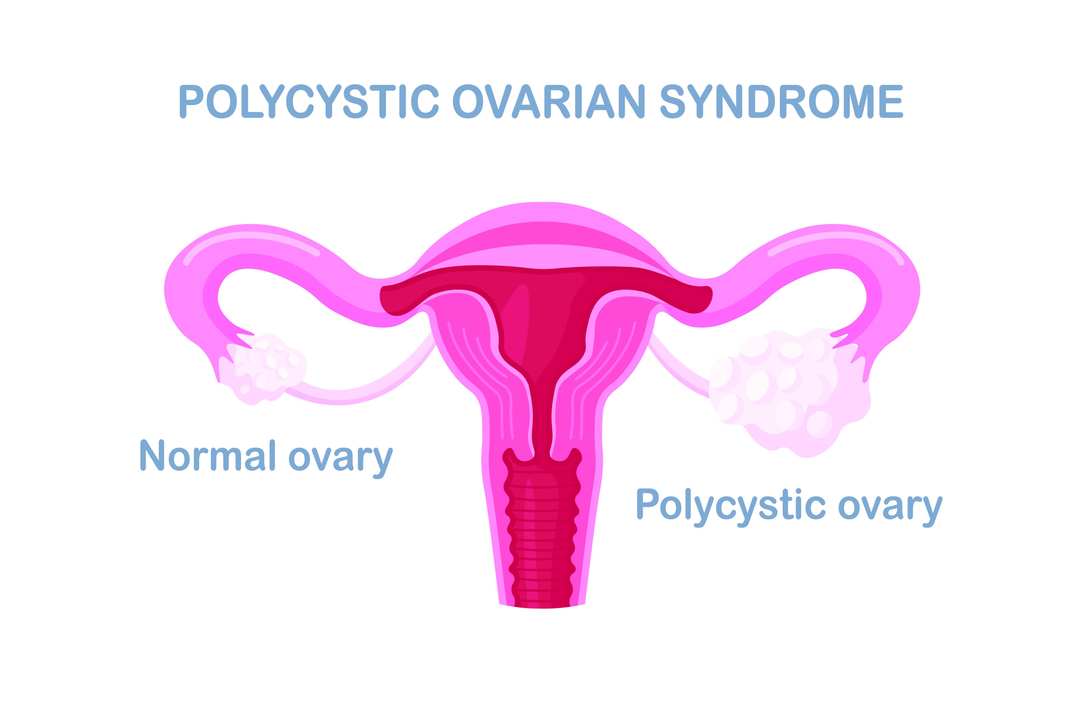 Polycystic Ovarian Syndrome