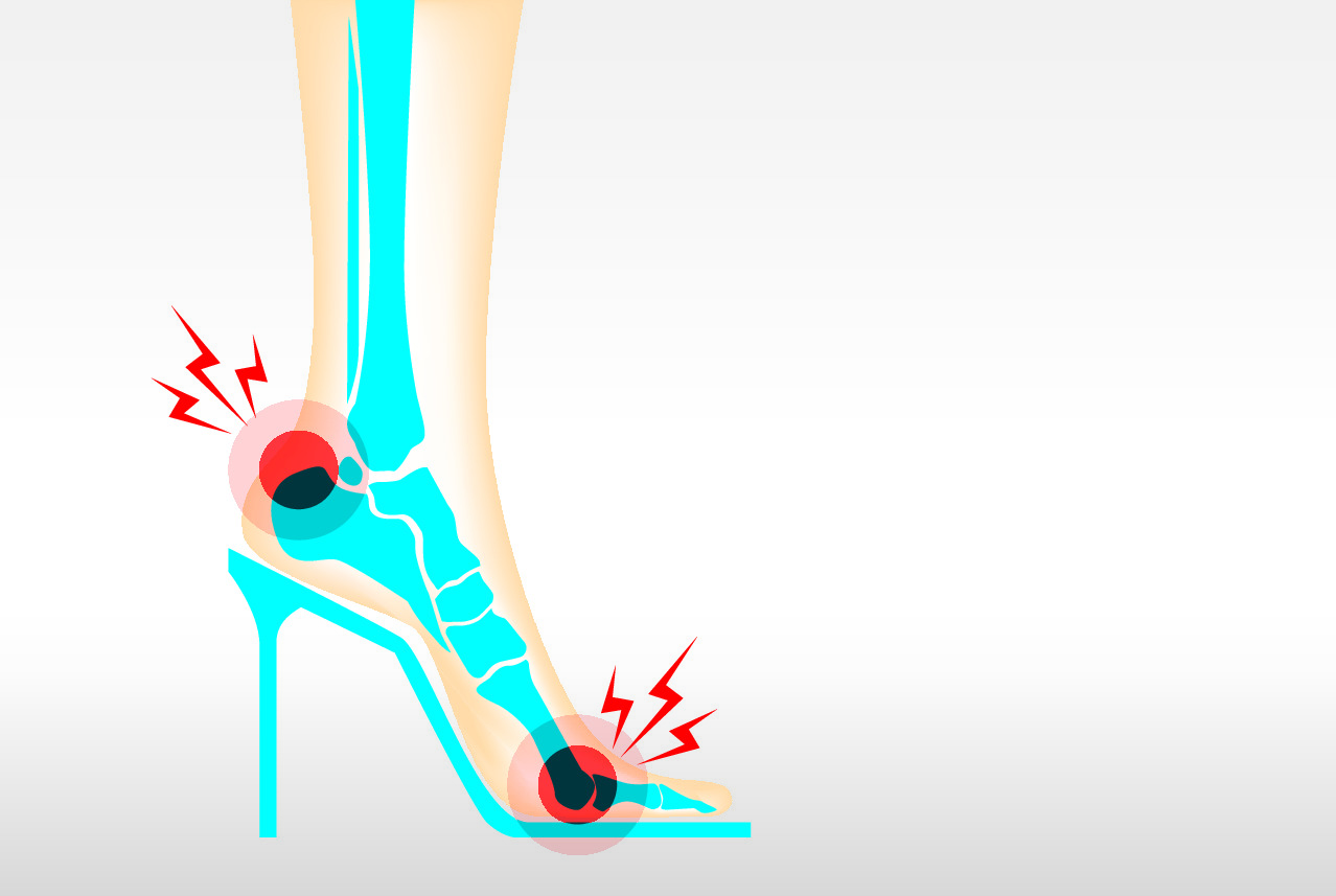 high heels cause bone damage and muscles