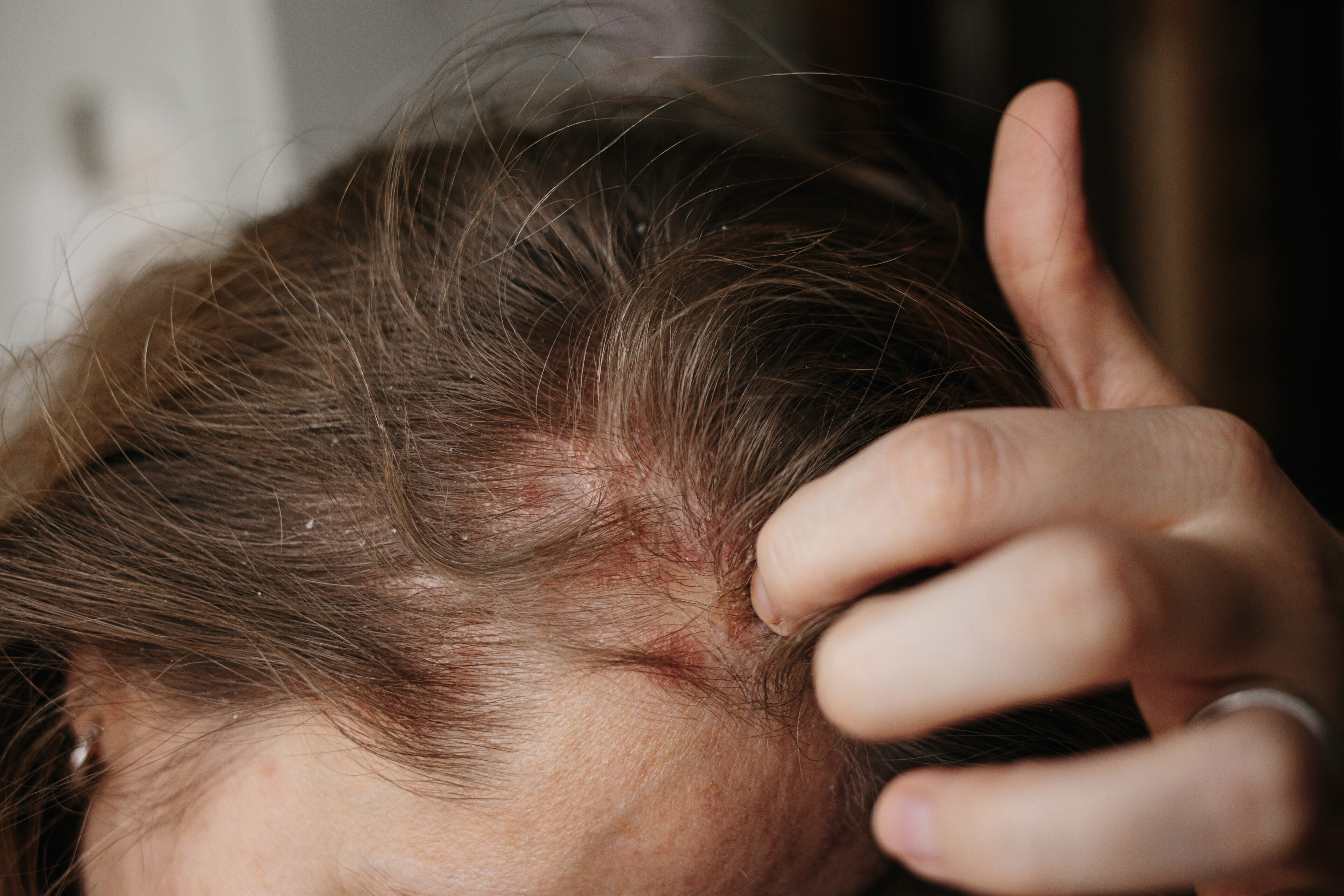 You have a history of scalp problems